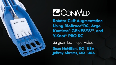 Drs. Sean McMillan &amp; Jeffrey Abrams - Rotator Cuff Augmentation Using BioBrace® RC Delivery System, Argo Knotless® GENESYS™ and Y-Knot® PRO RC