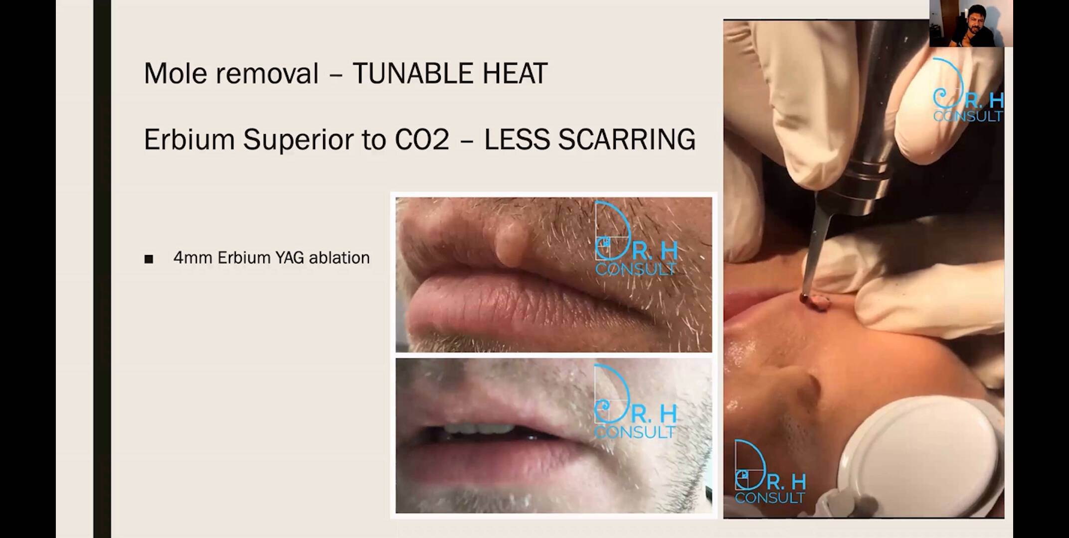 Thumbnail for Change Your Game: Resurfacing Skin of Color with Sciton Er:YAG