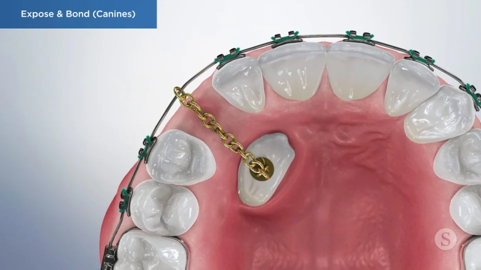 impacted canine teeth