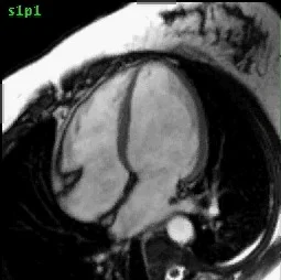 SSFP: Function - Cardiac MRI