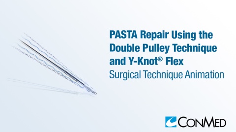 PASTA Repair Using the Double Pulley Technique and Y-Knot® Flex