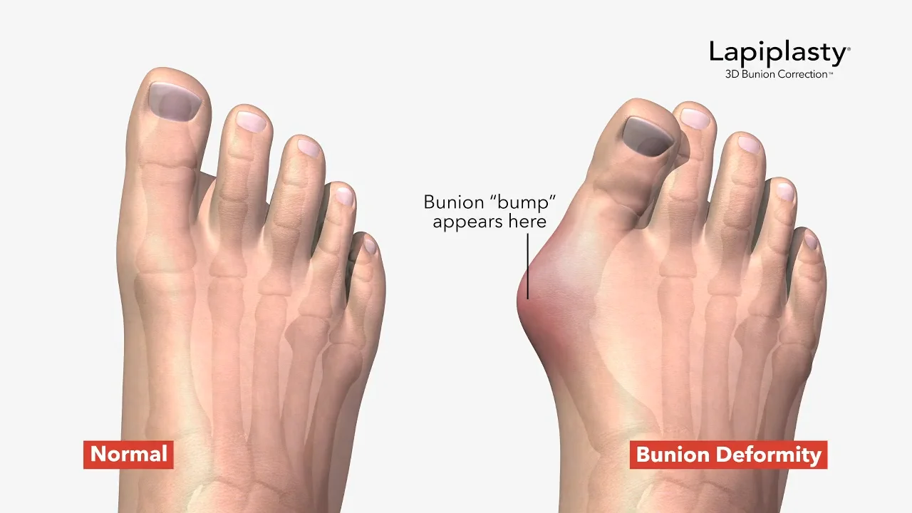 Lapiplasty Bunion Surgery, 3D Bunion Correction, University, 45% OFF