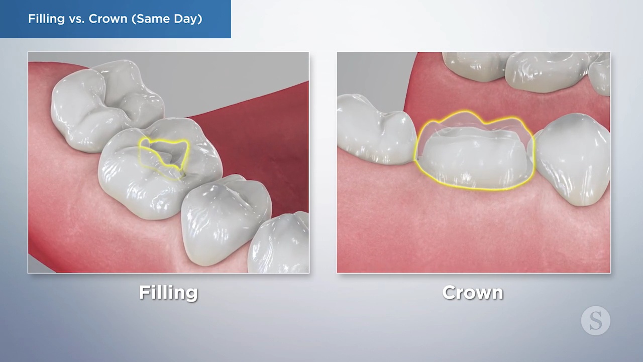 video image filling vs crown