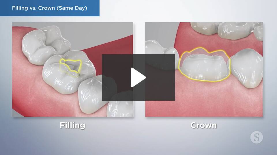 video image filling vs crown