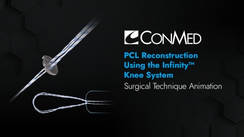 PCL Reconstruction Using the Infinity™ Knee System
