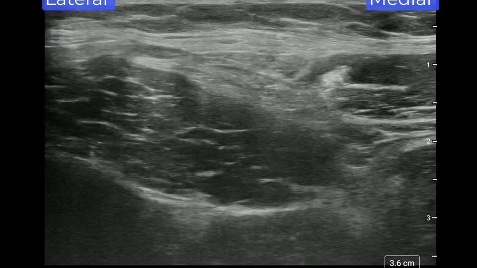 Ultrasound-Guided Lateral Femoral Cutaneous Nerve Block | CSurgeries