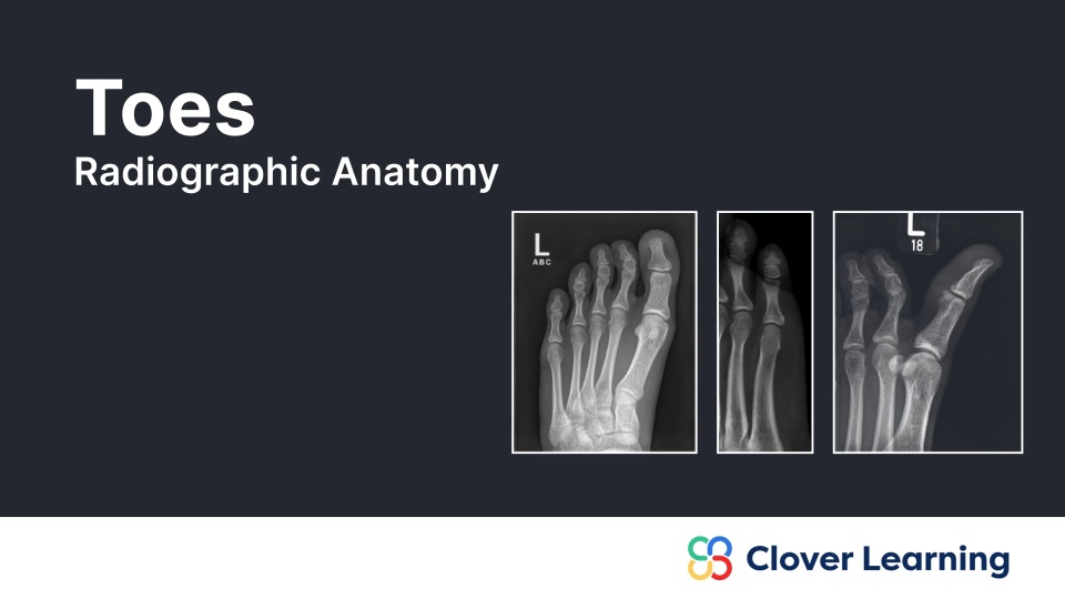 Toes: Radiographic Anatomy | Video Lesson | Clover Learning