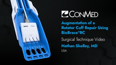 Dr. Nathan Skelley - Augmentation of a Rotator Cuff Repair Using BioBrace®RC