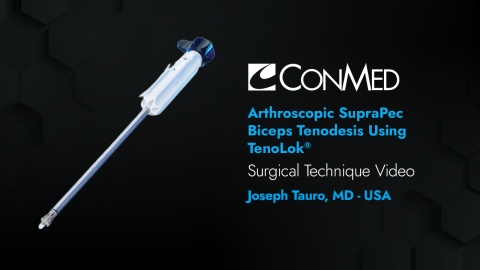 Dr. Tauro - Arthroscopic SupraPec Biceps Tenodesis Using TenoLok®