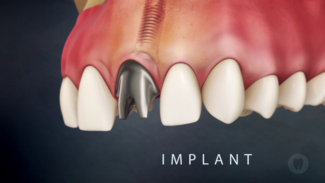 Bridge VS Implant