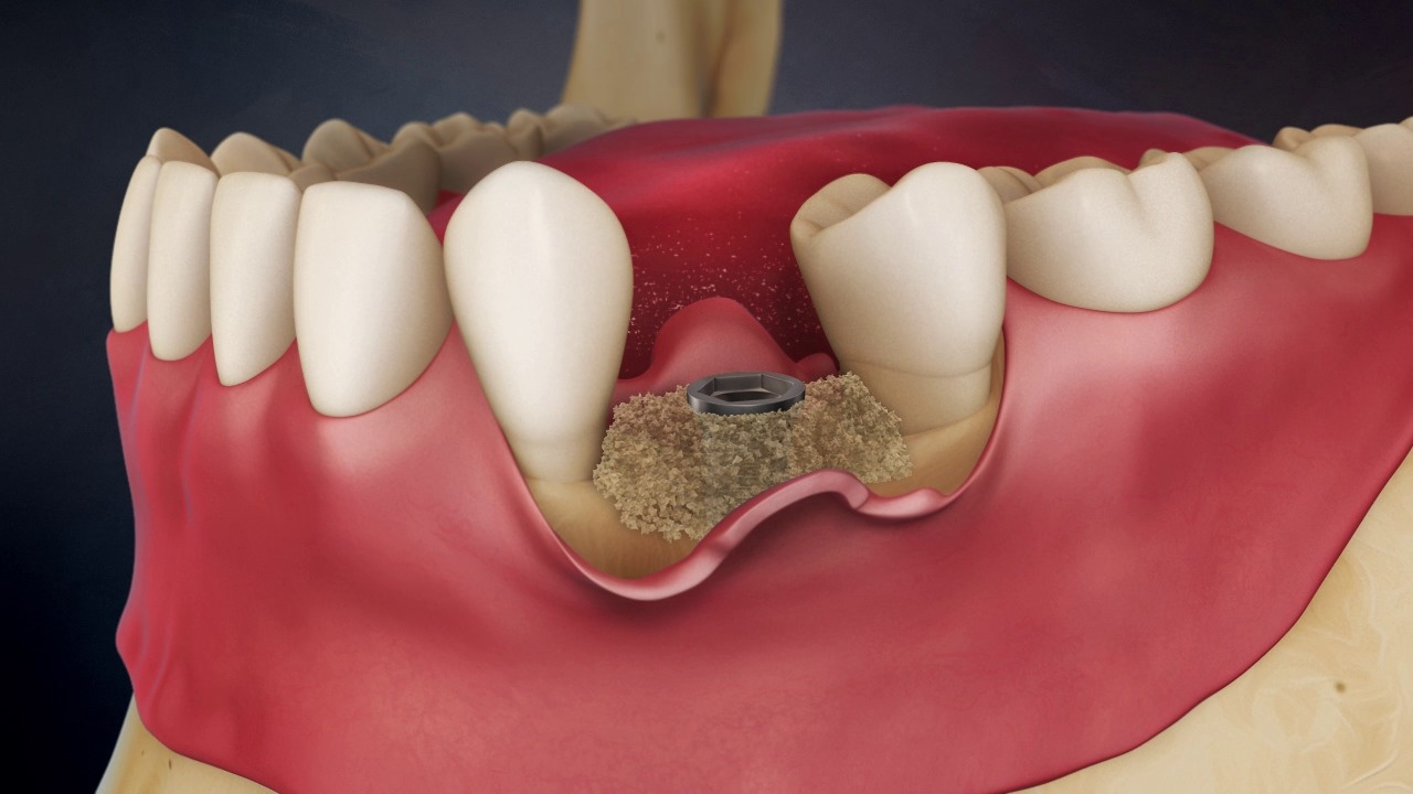 Toothloss: Graft at Time of Implant Placement