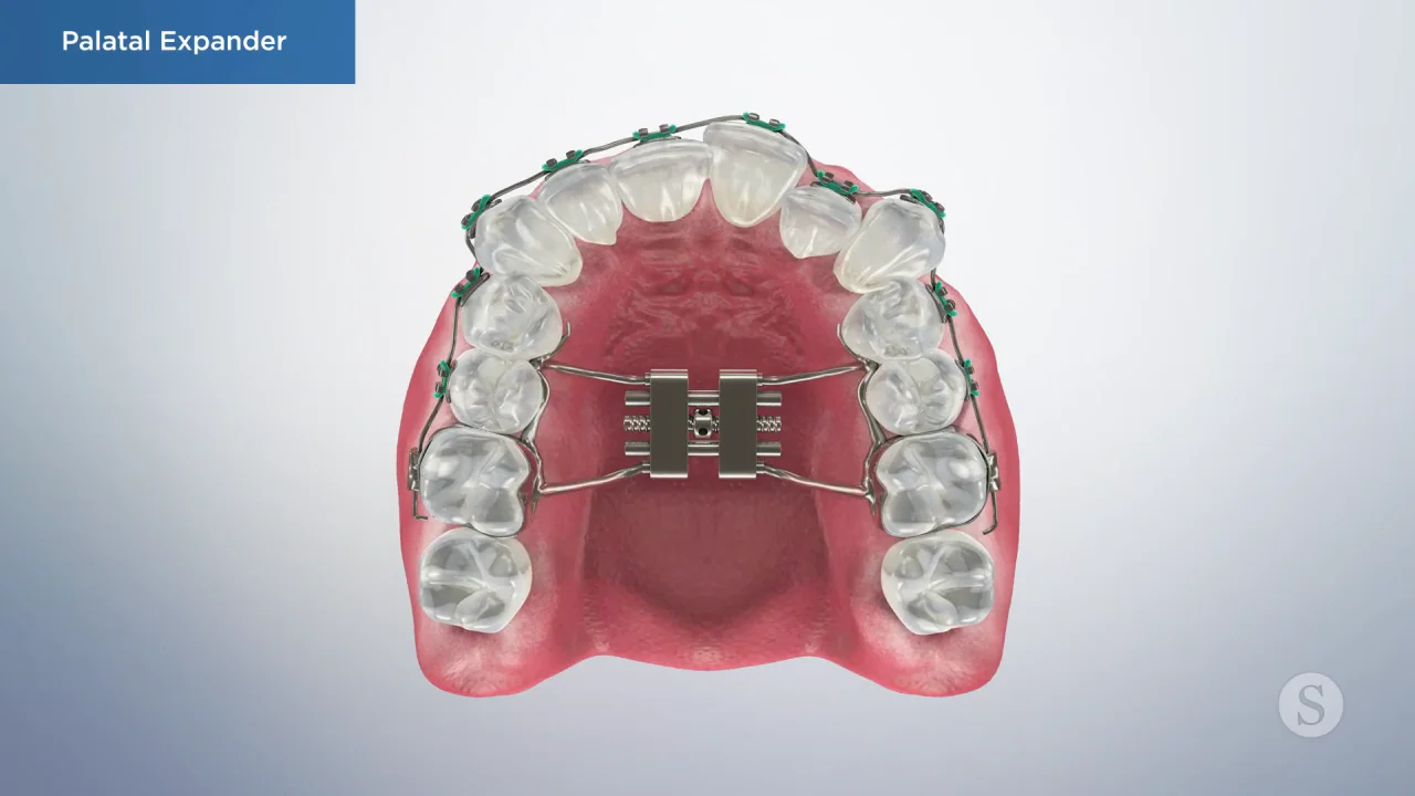 Palatal Expander Treatment in Red Lion and York - F&S