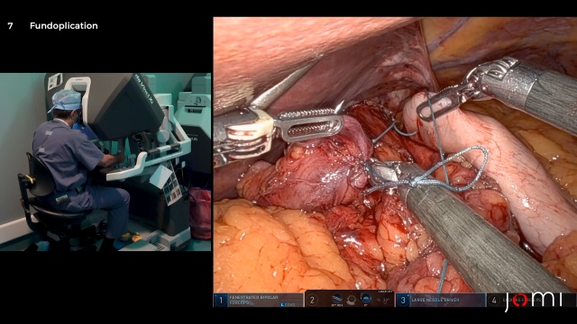 Robotic Preperitoneal Umbilical Hernia Repair - BroadcastMed