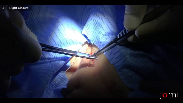 Inguinal hernia repair (child)