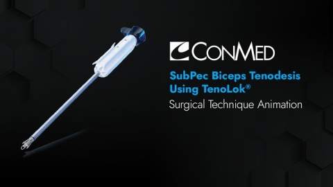 SubPec Biceps Tenodesis Using TenoLok®
