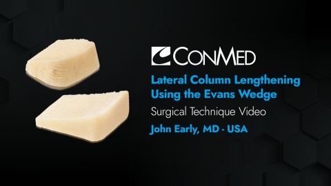 Dr. Early - Lateral Column Lengthening Using the Evans Wedge