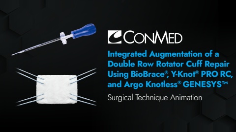 Integrated Augmentation of Double Row Rotator Cuff Repair Using BioBrace®, Y-Knot® PRO RC, and Argo Knotless® GENESYS™