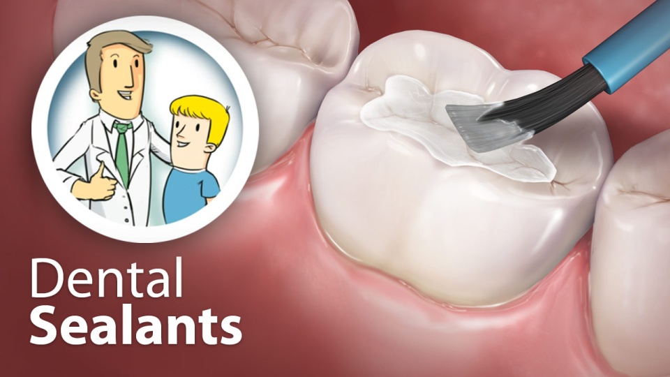 Decay Dilemma: Dental Sealants to Protect Kids Teeth