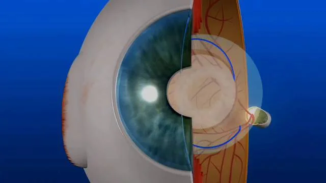 Cataracts Cedar Rapids | Cataract Surgery West Des Moines