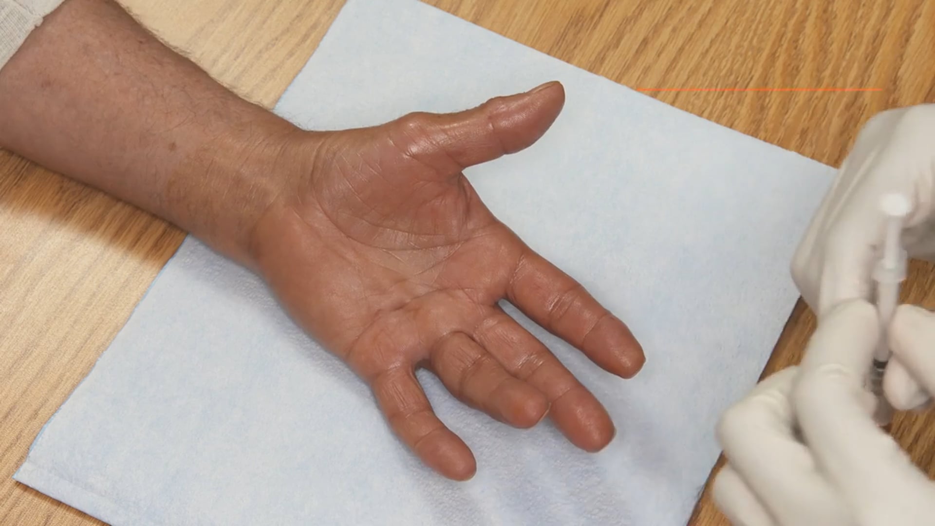 Robert Coats II, MD: Single-joint fourth finger MP 30° procedure video thumbnail