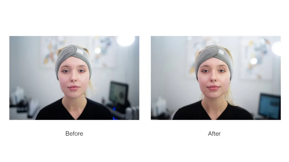 Hydrafacial Treatment London