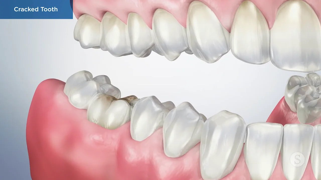 Cracked Teeth Treatment in Florida