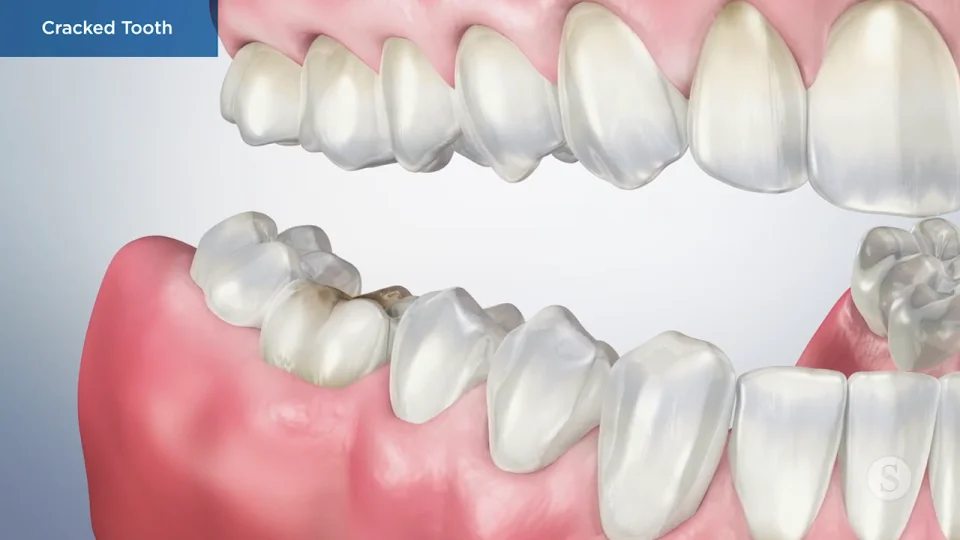 Dental Treatment Options to Repair a Cracked Tooth - Lasting Impressions  Dental Group Houston TX