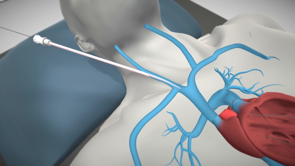 ProtekDuo Cannulation Animation video thumbnail