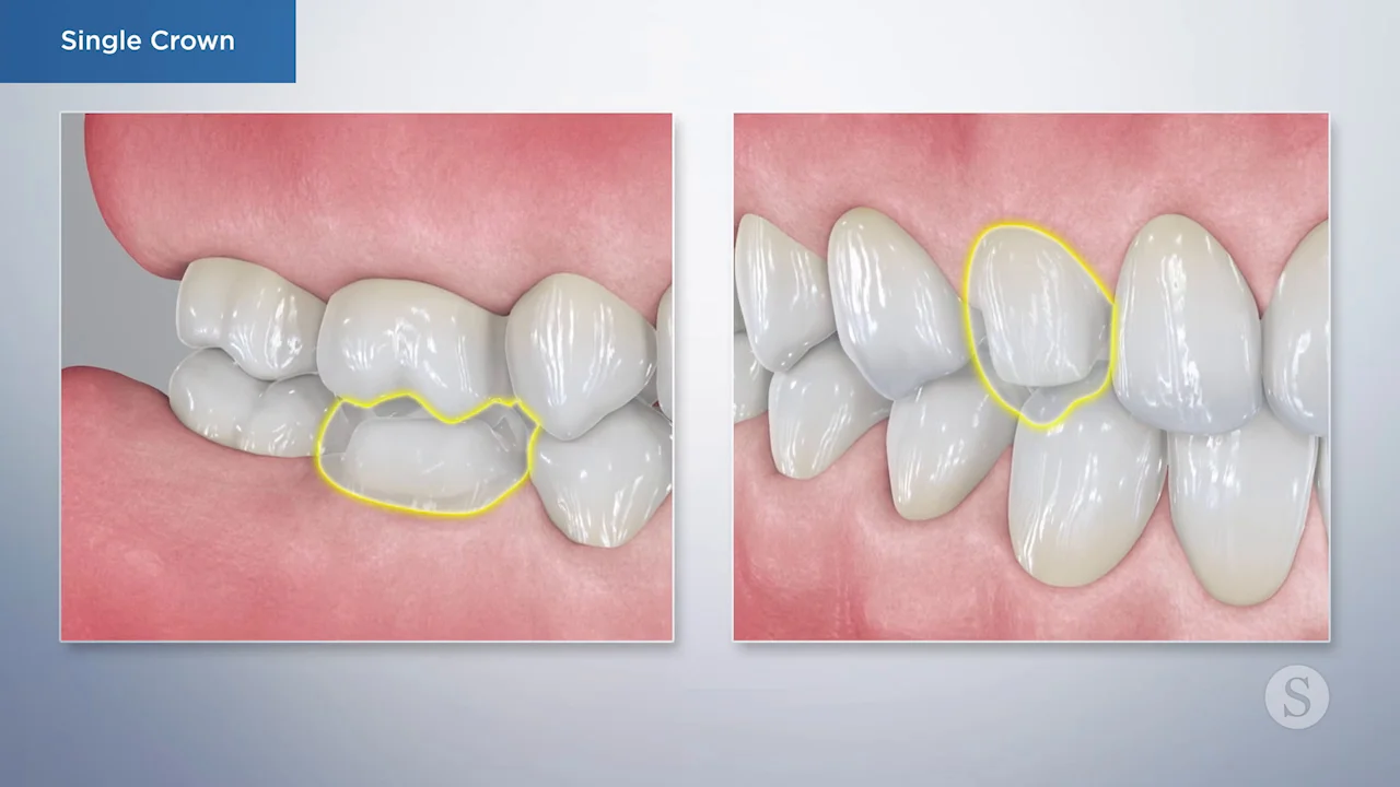 Dental Abrasions and Cracks - Implants, Wisdom tooth surgery, Root Canal  treatment, Crowns, Emergencies
