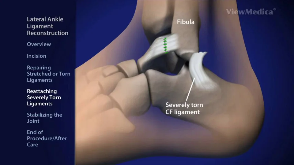 Ankle Joint Anatomy: Overview, Lateral Ligament Anatomy and