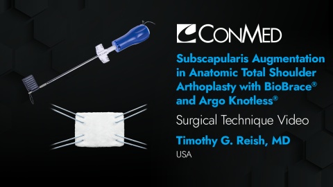 Dr. Reish - Subscapularis Augmentation in Anatomic TSA with BioBrace® and Argo Knotless®