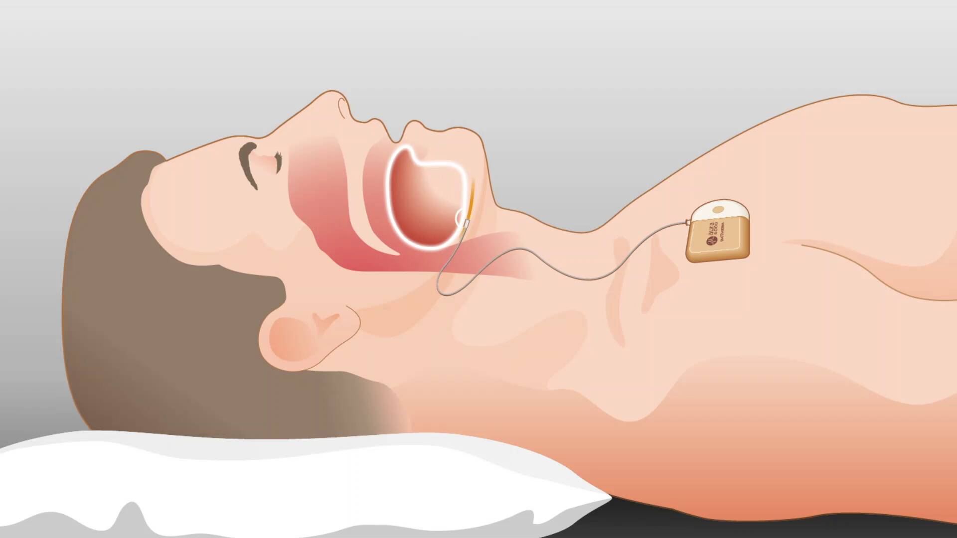 Treating OSA with Neurostimulation and Aura6000