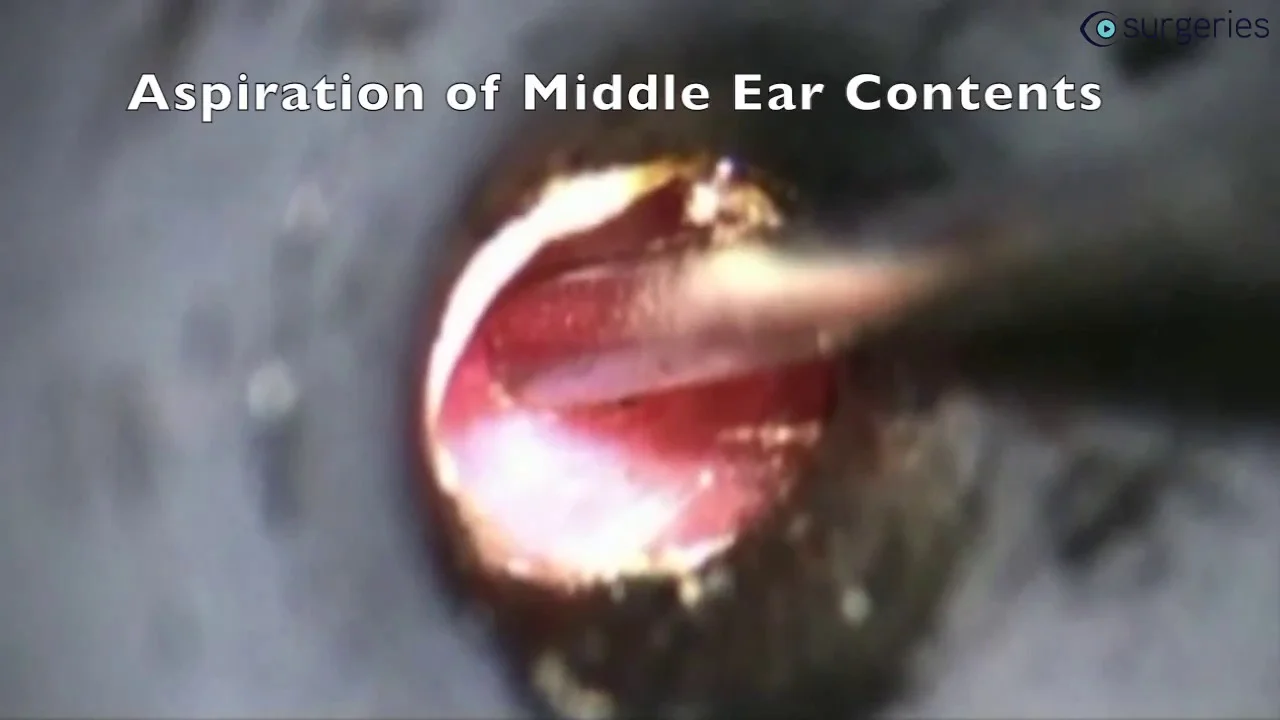 Ear Tubes (Tympanostomy): Definition & Procedure