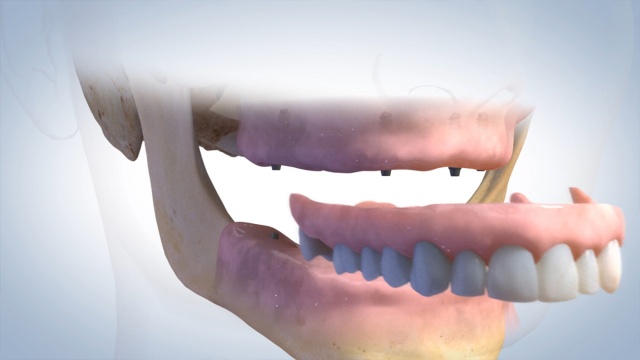 implants_24fps
