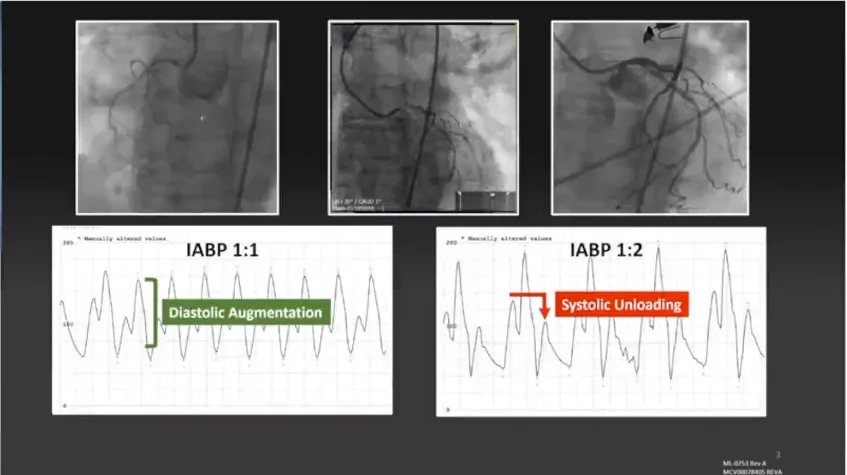 Critical Analysis of Coronary Artery Bypass Graft Surgery: A 30