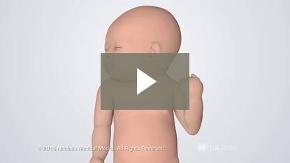 What is HLHS in a baby