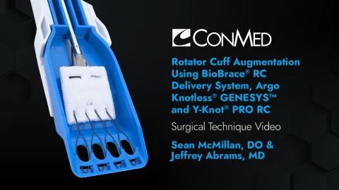 Drs. Sean McMillan & Jeffrey Abrams - Rotator Cuff Augmentation Using BioBrace® RC Delivery System, Argo Knotless® GENESYS™ and Y-Knot® PRO RC