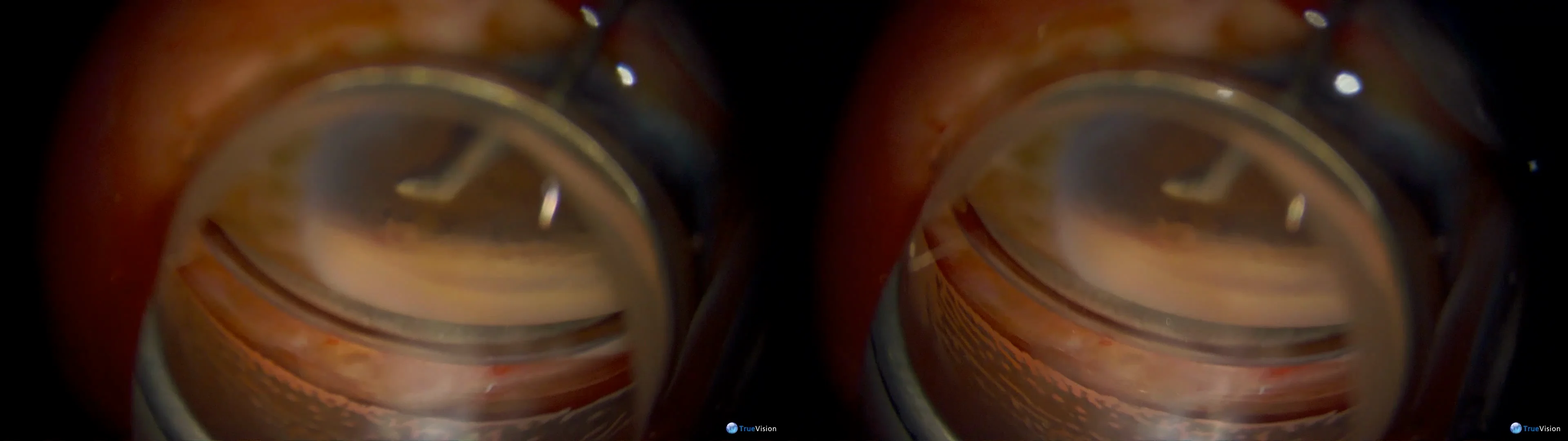 3D Surgery_ Goniotomy using the Kahook Dual Blade, image size:3840x1080