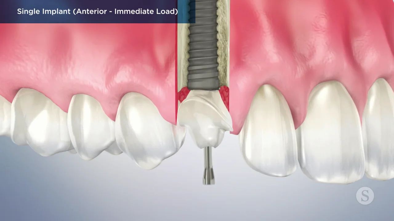 Dental Implants