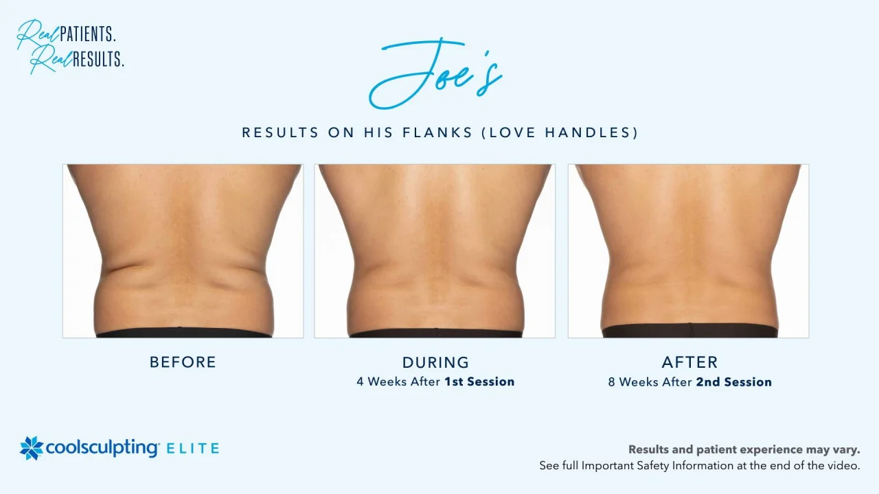 Coolsculpting treatment Before & After photos at 8 West Clinic