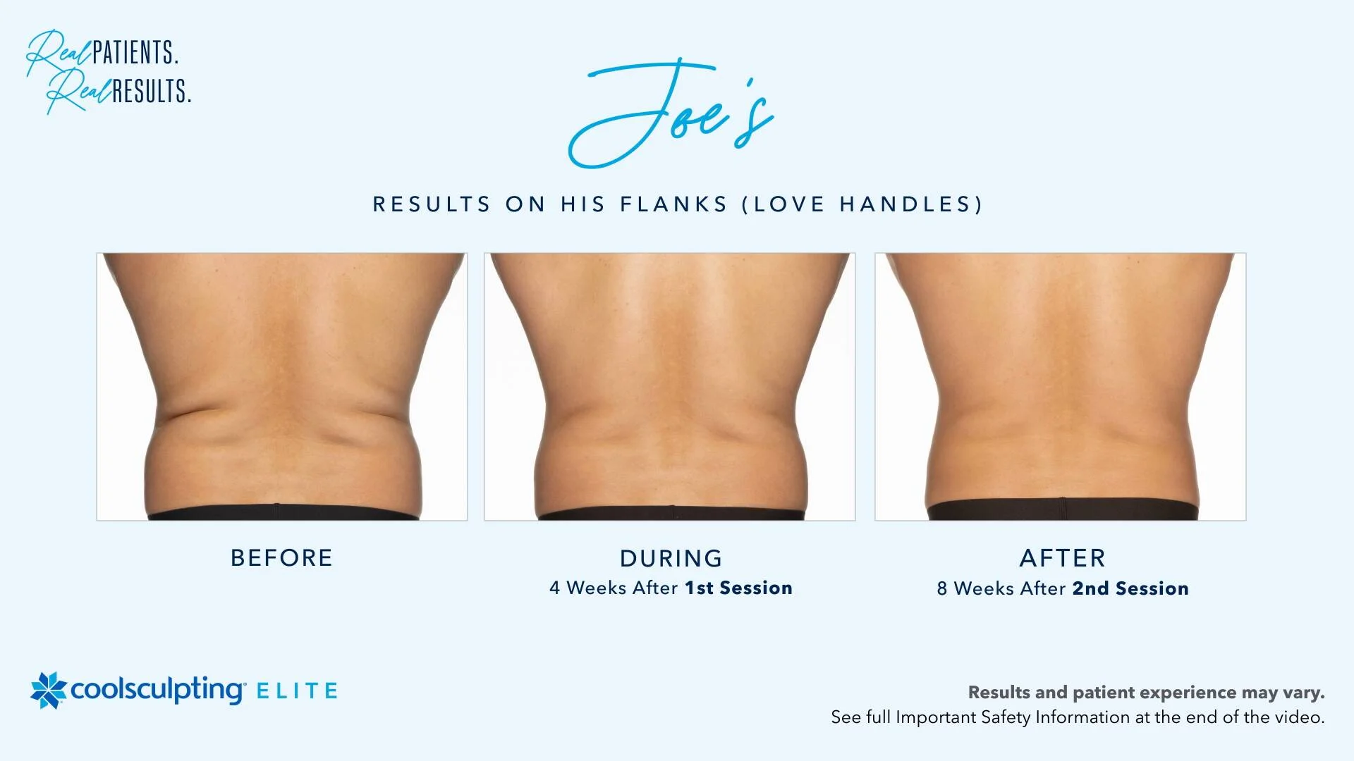 Two CoolSculpting® sessions on the flanks helped this patient achieve his  goals of reducing stubborn fat on his love handles. Individual…