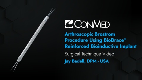Arthroscopic Brostrom Procedure Using BioBrace® Reinforced Bioinductive Implant - Jay Badell, DPM