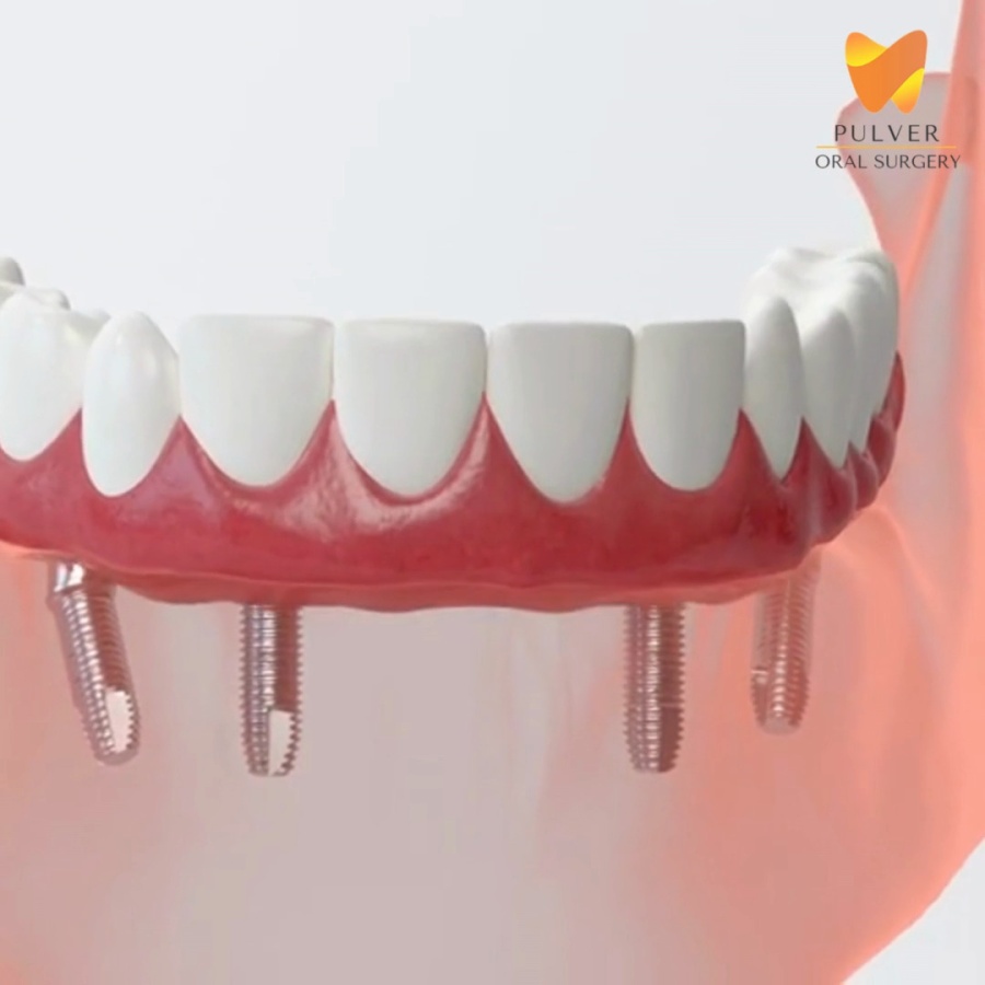 <p>Right after replacing multiple teeth picture.</p>