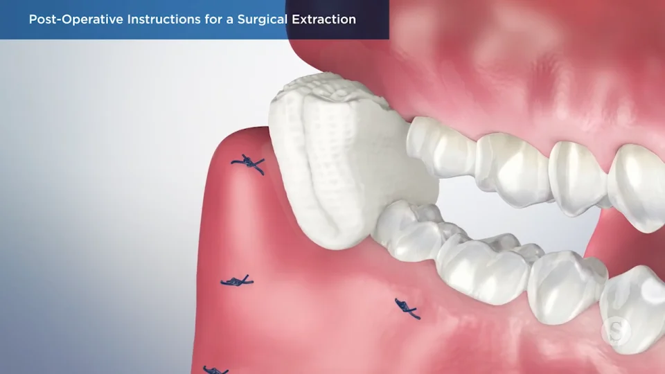 post wisdom tooth extraction care instructions