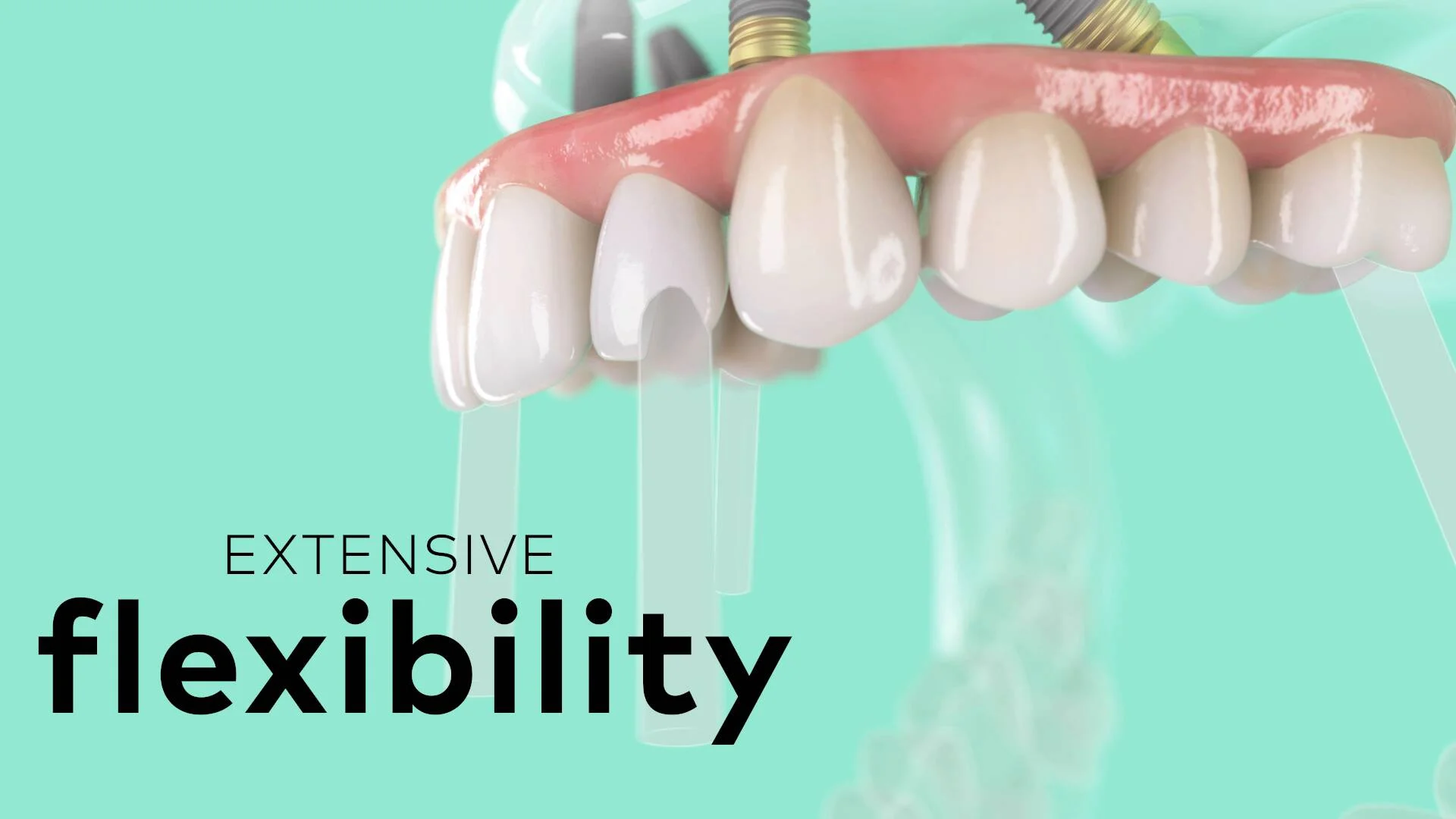 GMT 70560 NobelProcera Zirconia Implant Bridge Animation