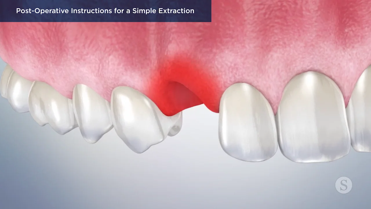 Post-Op Sensitivity after Composite Fillings