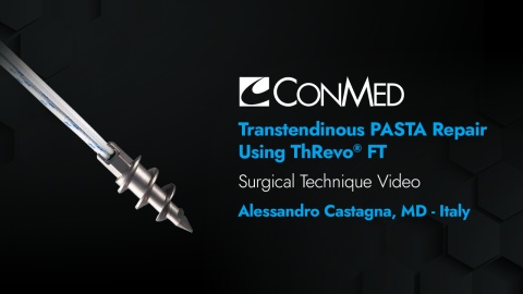 Dr. Castagna - Transtendinous PASTA Repair Using the ThRevo® FT Anchor