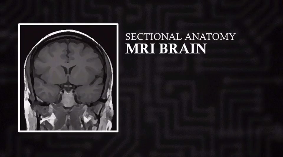 MRI Brain (Coronal) | Video Lesson | Clover Learning