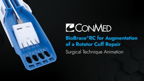 BioBrace®RC for Augmentation of a Rotator Cuff Repair