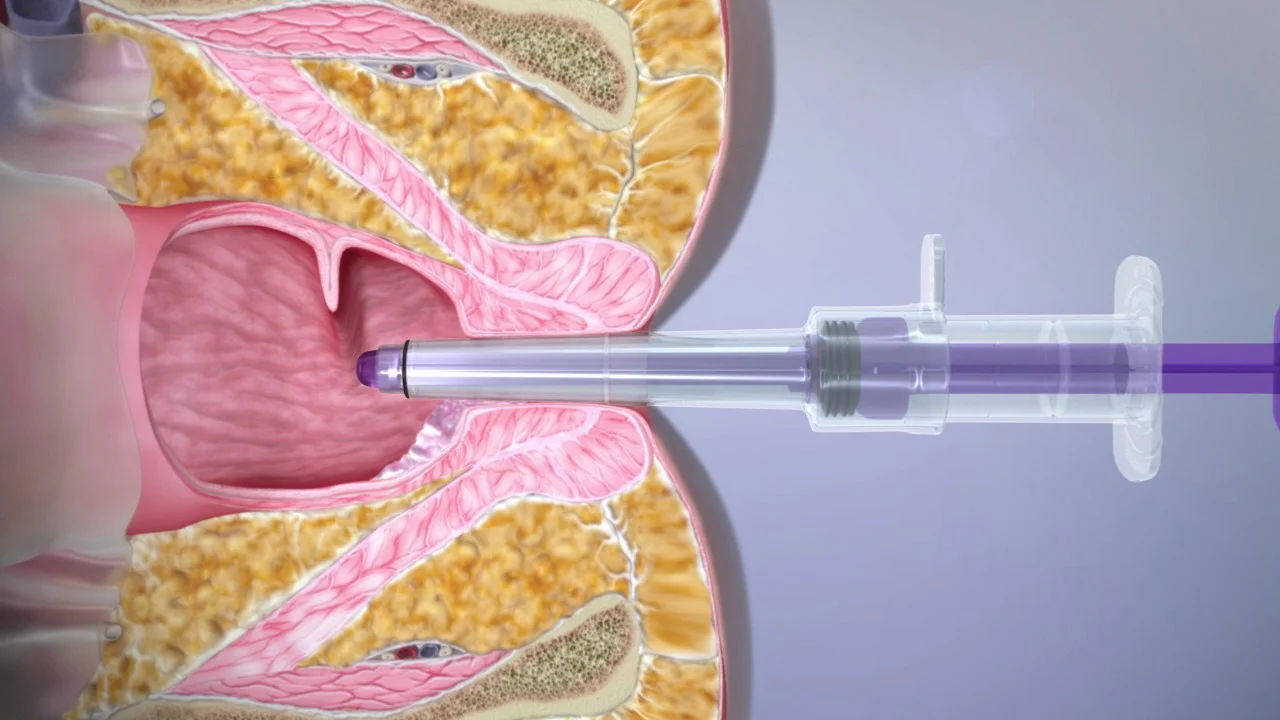 CRH O'Regan System: NonSurgical Hemorrhoid Banding Treatment